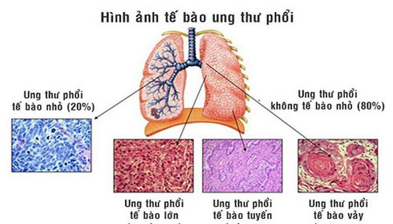 ĐIỀU TRỊ UNG THƯ PHỔI TẾ BÀO NHỎ